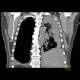 Fluidothorax, hemothorax and pneumothorax, complication of evacuation: CT - Computed tomography